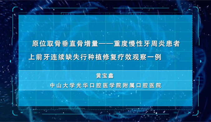 原位取骨垂直股增量—重度慢性牙周炎患者上前牙连续缺失行种植修复疗效观察一例