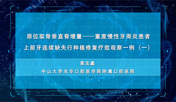 原位取骨垂直骨增量—重度慢性牙周炎患者上前牙连续缺失行种植修复疗效观察一例（一）