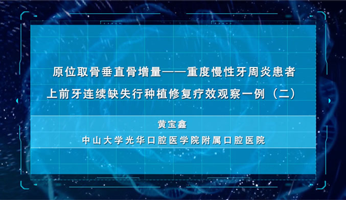 原位取骨垂直骨增量—重度慢性牙周炎患者上前牙连续缺失行种植修复疗效观察一例（二）