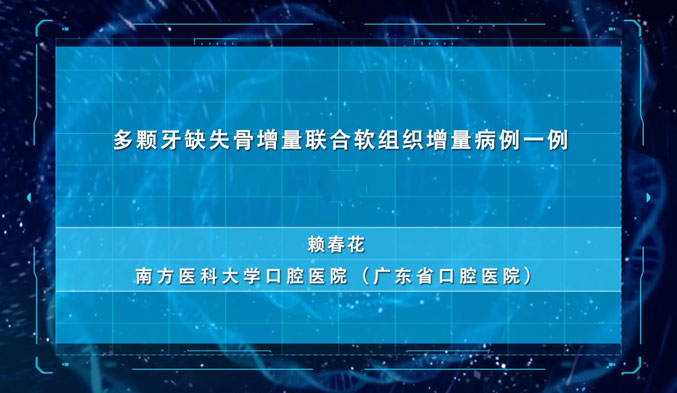 多颗牙缺失骨增量联合软组织增量病例一例