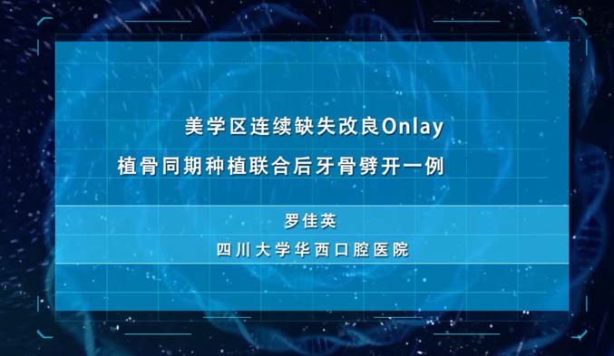 美学区连续缺失改良Onlay植骨同期种植联合后牙骨劈开一例