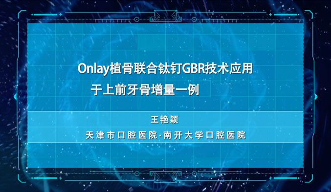 Onlay植骨联合钛钉GBR技术应用于上前牙骨增量一例