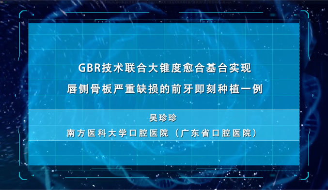 GBR技术联合大锥度愈合基台实现唇侧骨板严重缺损的前牙即刻种植一例