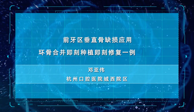 前牙区垂直骨缺损应用环骨合并即刻种植即刻修复一例