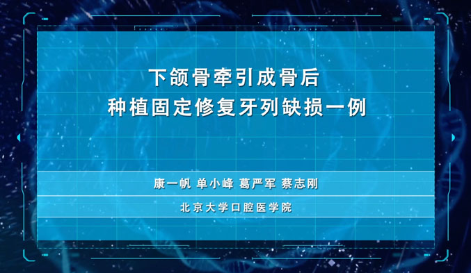 下颌骨牵引成骨后种植固定修复牙列缺损一例