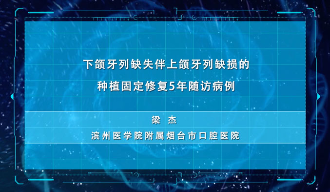 下颌牙列缺失伴上颌牙列缺损的种植固定修复5年随访病例