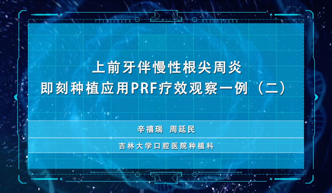 上前牙伴慢性根尖周炎即刻种植应用PRF疗效观察一例（二）