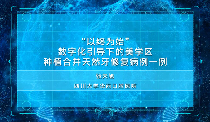 “以终为始”——数字化引导下的美学区种植合并天然牙修复病例一例