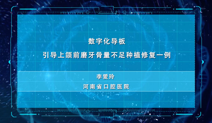 数字化导板引导上颌前磨牙骨量不足种植修复一例