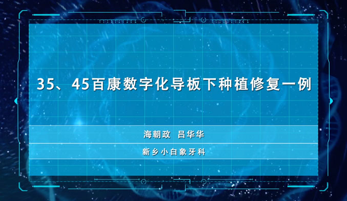 35、45百康数字化导板下种植修复一例