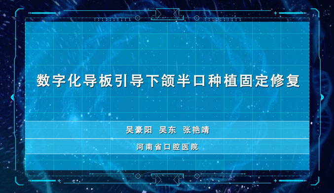 数字化导板引导下颌半口种植固定修复