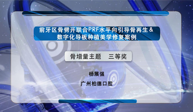 前牙区骨劈开联合PRF水平向引导骨再生&数字化导板种植美学修复案例