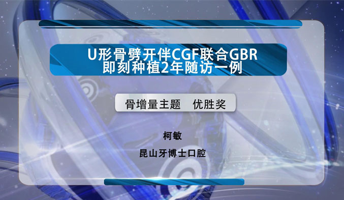 U形骨劈开伴CGF联合GBR即刻种植2年随访一例