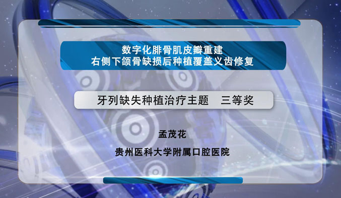 数字化腓骨肌皮瓣重建右侧下颌骨缺损后种植覆盖义齿修复