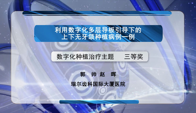 利用数字化多层导板引导下的上下无牙颌种植病例一例