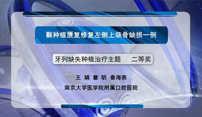 颧种植赝复修复左侧上颌骨缺损一例