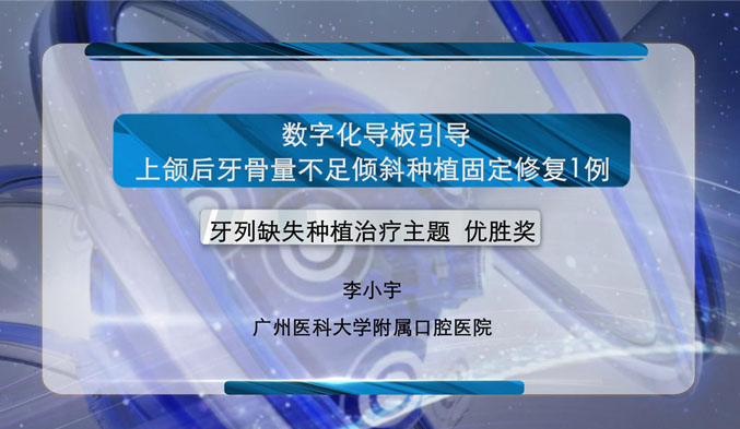 数字化导板引导上颌后牙骨量不足倾斜种植固定修复一例