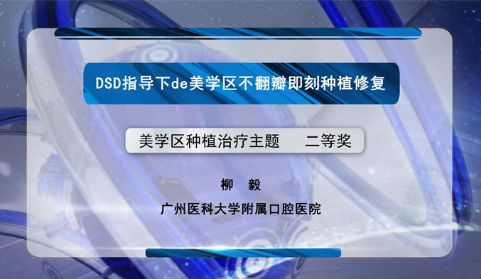 DSD指导下的美学区不翻瓣即刻种植修复