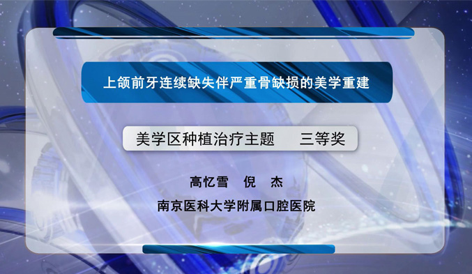 上颌前牙连续缺失伴严重骨缺损的美学重建