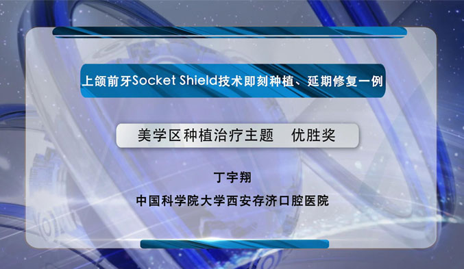 上颌前牙Socket Shield技术即刻种植、延期修复一例