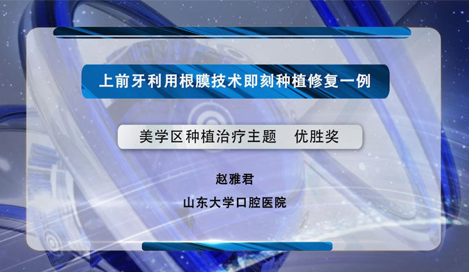 上前牙利用根膜技术即刻种植修复一例