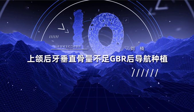 上颌后牙垂直骨量不足GBR后导航种植