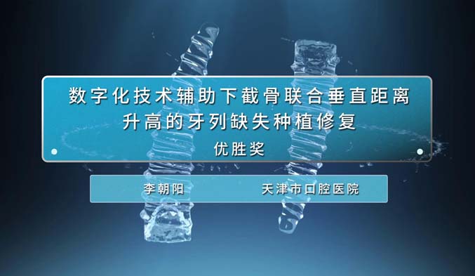 数字化技术辅助下截骨联合垂直距离升高的牙列缺失种植修复