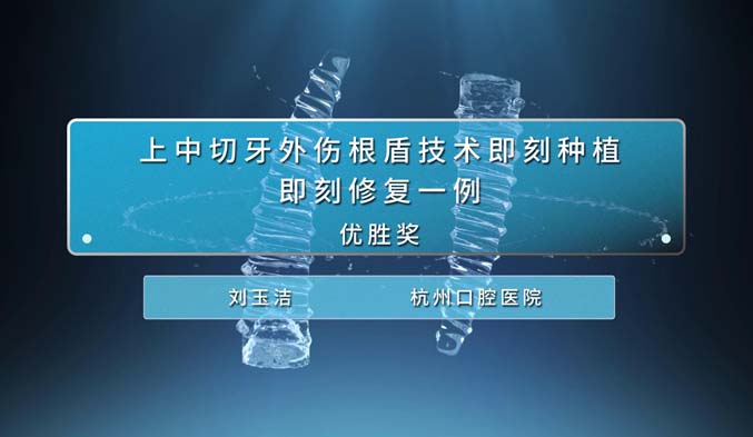 上中切牙外伤根盾技术即刻种植即刻修复一例