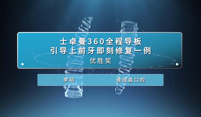 士卓曼360全程导板引导上前牙即刻修复一例