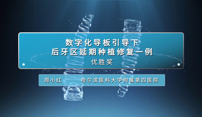 数字化导板引导下后牙区延期种植修复一例