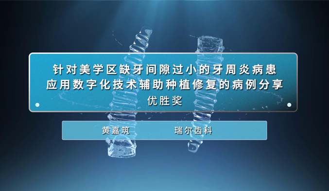 针对美学区缺牙间隙过小的牙周炎病患应用数字化技术辅助种植修复的病例分享