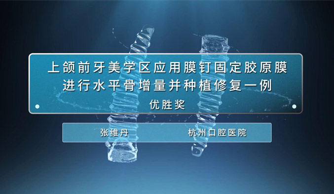 上颌前牙美学区应用膜钉固定胶原膜进行水平骨增量并种植修复一例