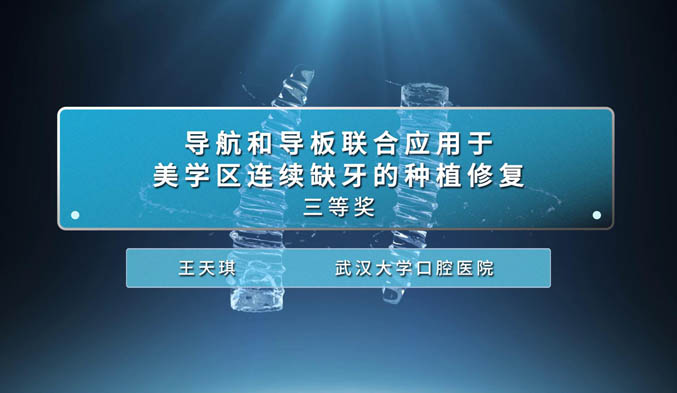 导航和导板联合应用于美学区连续缺牙的种植修复