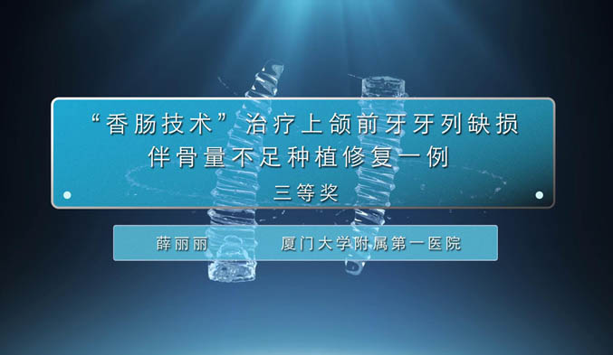 “香肠技术”治疗上颌前牙牙列缺损伴骨量不足种植修复一例