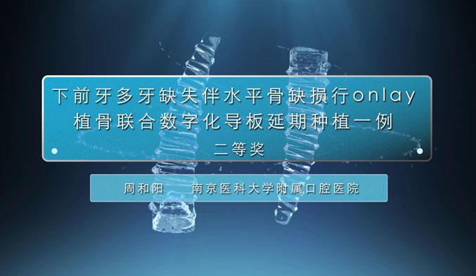 下前牙多牙缺失伴水平骨缺损行Onlay植骨联合数字化导板延期种植一例