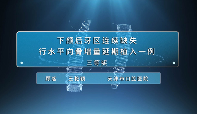 下颌后牙区连续缺失行水平向骨增量延期植入一例