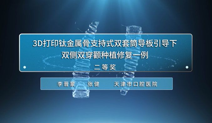 3D打印钛金属骨支持式双套筒导板引导下双侧双穿颧种植修复一例