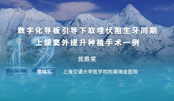 数字化导板引导下取埋伏阻生牙同期上颌窦外提升种植手术一例