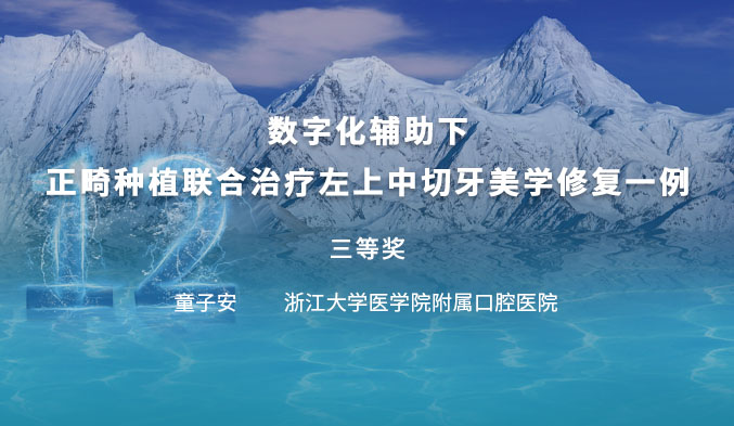 数字化辅助下正畸种植联合治疗左上中切牙美学修复一例