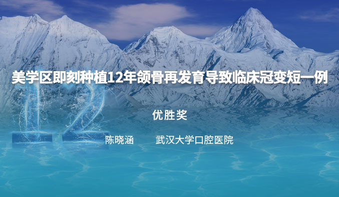 年轻女性美学区即刻种植后随访12年一例——颌骨再发育导致临床牙冠变短