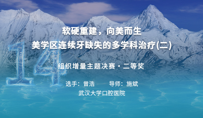 软硬重建，向美而生--美学区连续牙缺失的多学科治疗（二）