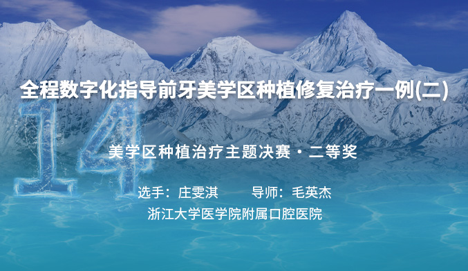 全程数字化指导前牙美学区种植修复治疗一例（二）