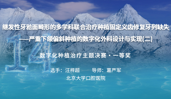 继发性牙𬌗面畸形的多学科联合治疗种植固定义齿修复牙列缺失 ——严重下颌偏斜种植的数字化外科设计与实现（二）