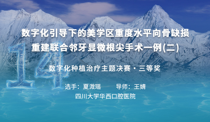 数字化引导下的美学区重度水平向骨缺损重建联合邻牙显微根尖手术一例（二）